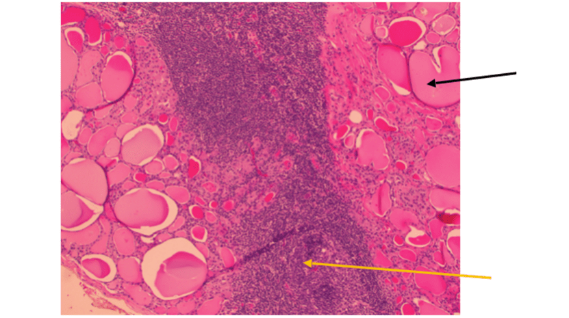 黑線指的是甲狀腺組織
黃線指的是激戰過後死掉的白血球們