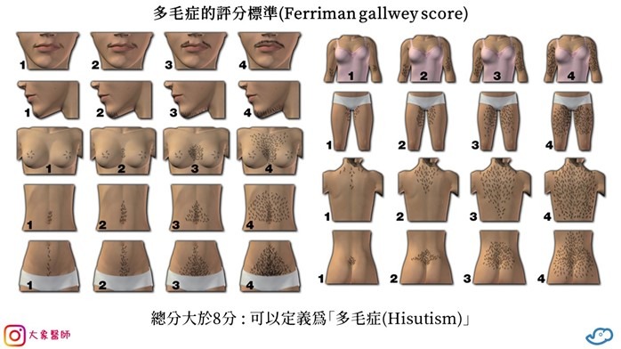 多毛症的診斷標準大象醫師