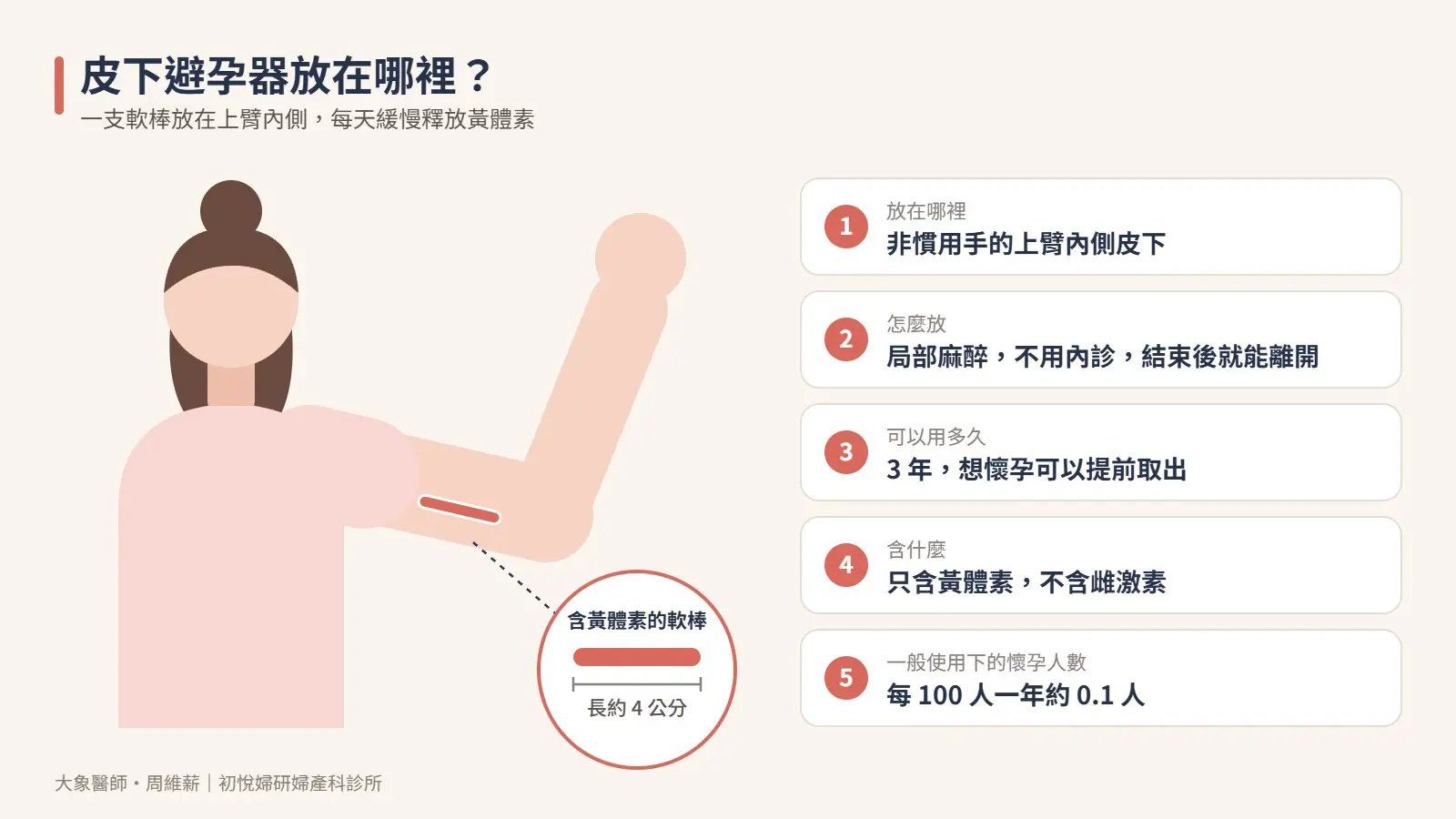 皮下避孕器放置位置示意圖：長約 4 公分的軟棒放在非慣用手上臂內側皮下